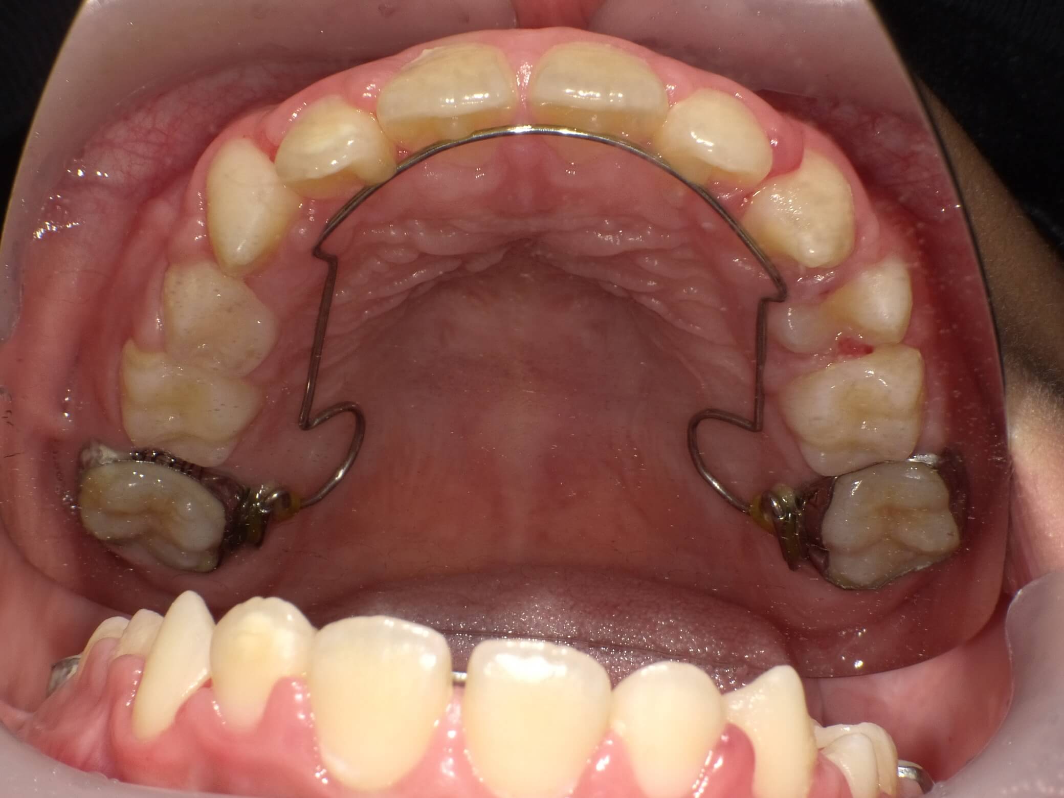 出っ歯と前歯のガタガタに対してBWSを併用した症例