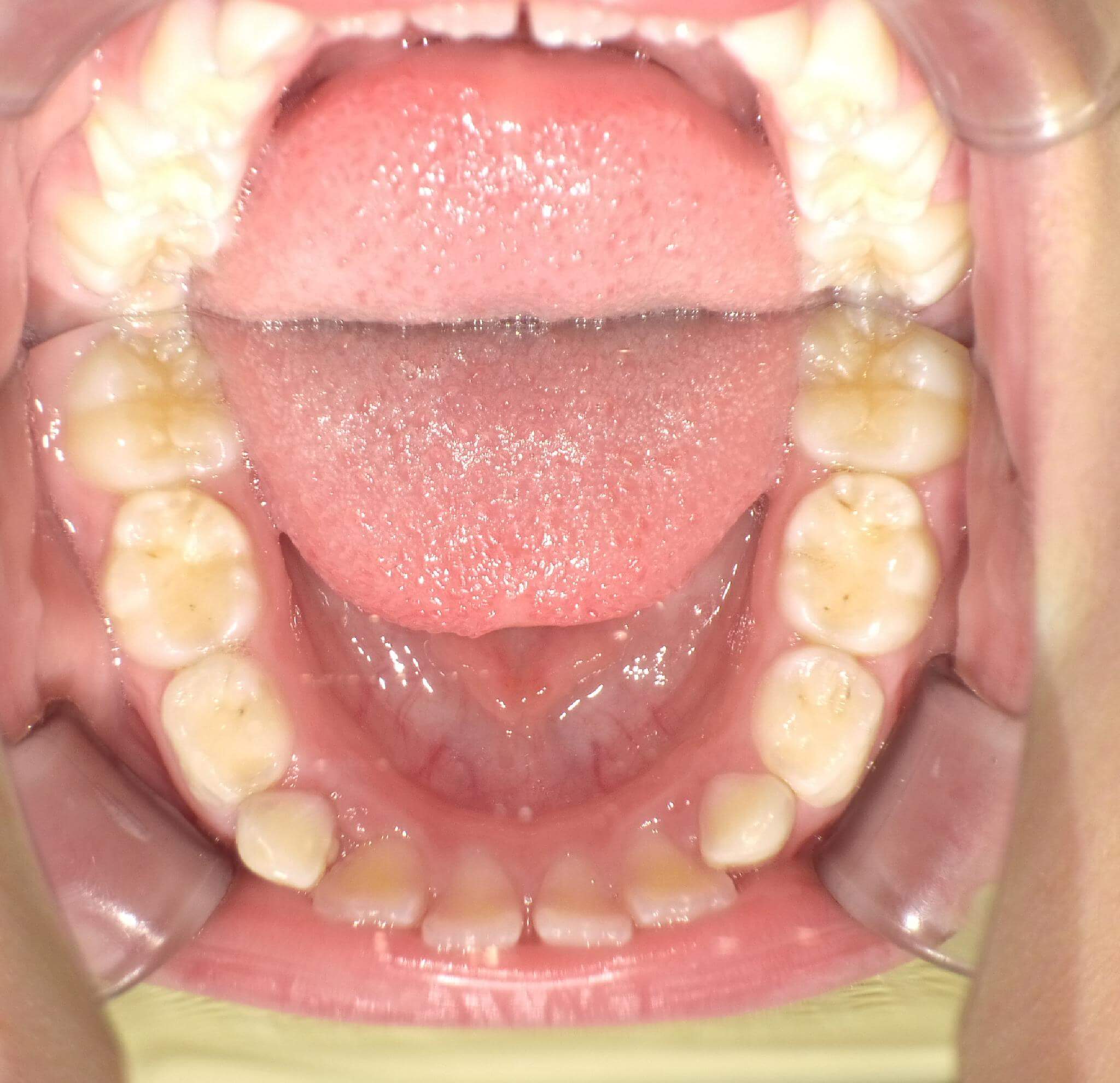 舌の前歯はスペースができるくらい改善しました。