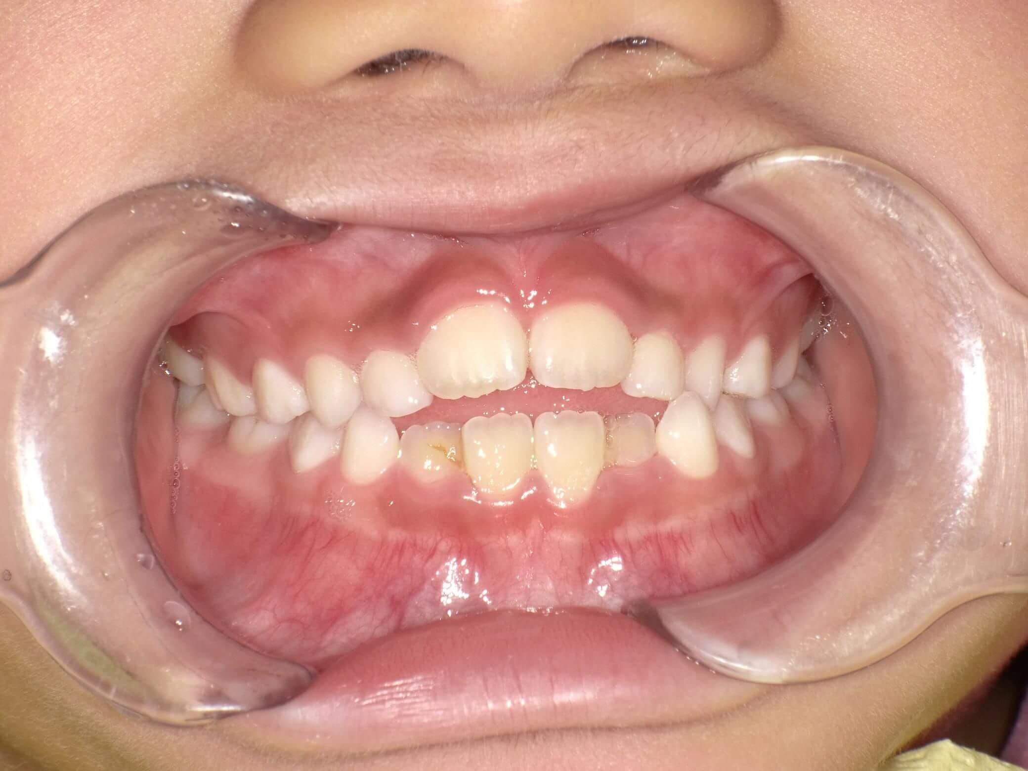 舌位が変わり出っ歯からきれいな歯列へ