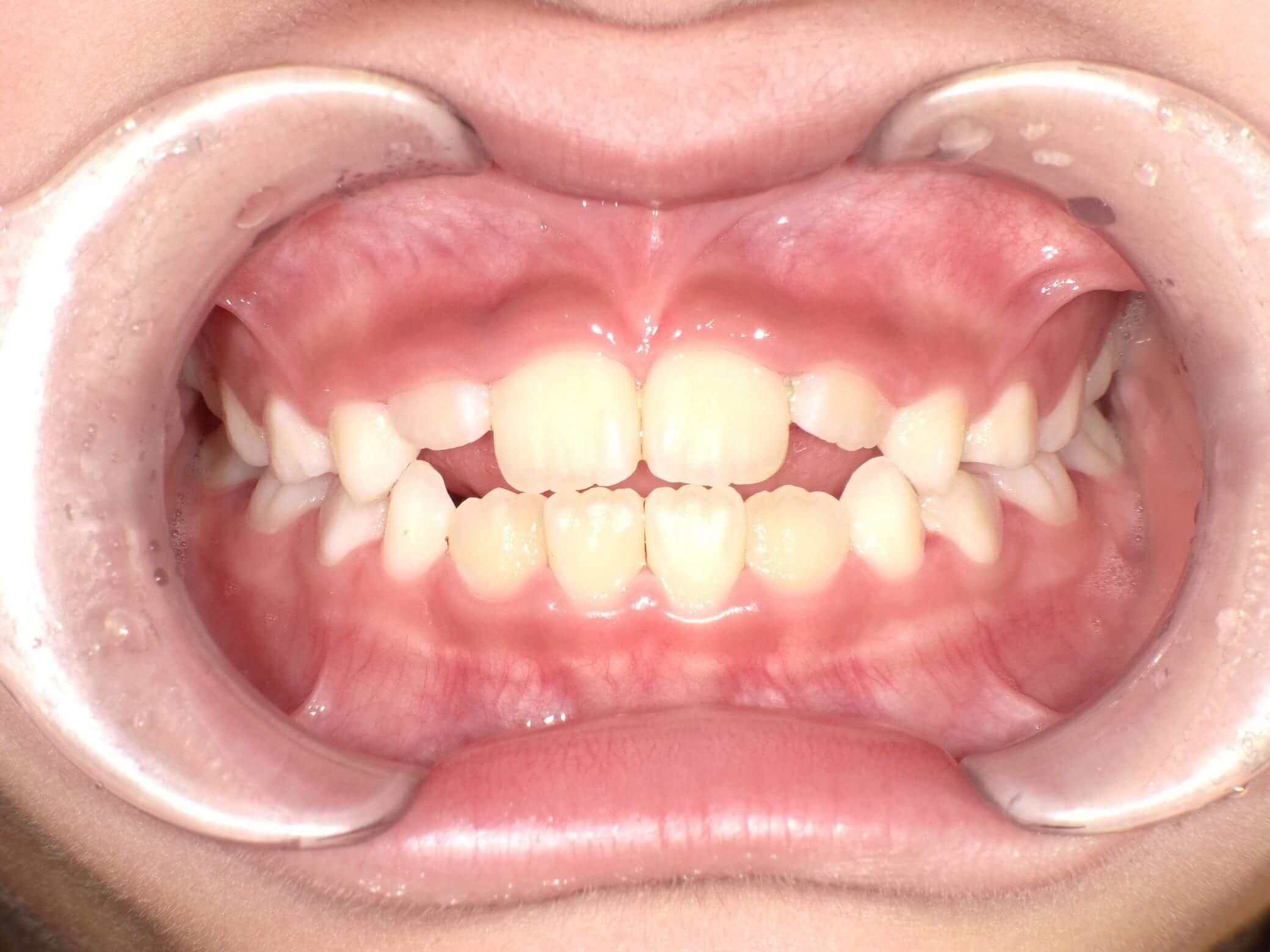 舌位が変わり出っ歯からきれいな歯列へ