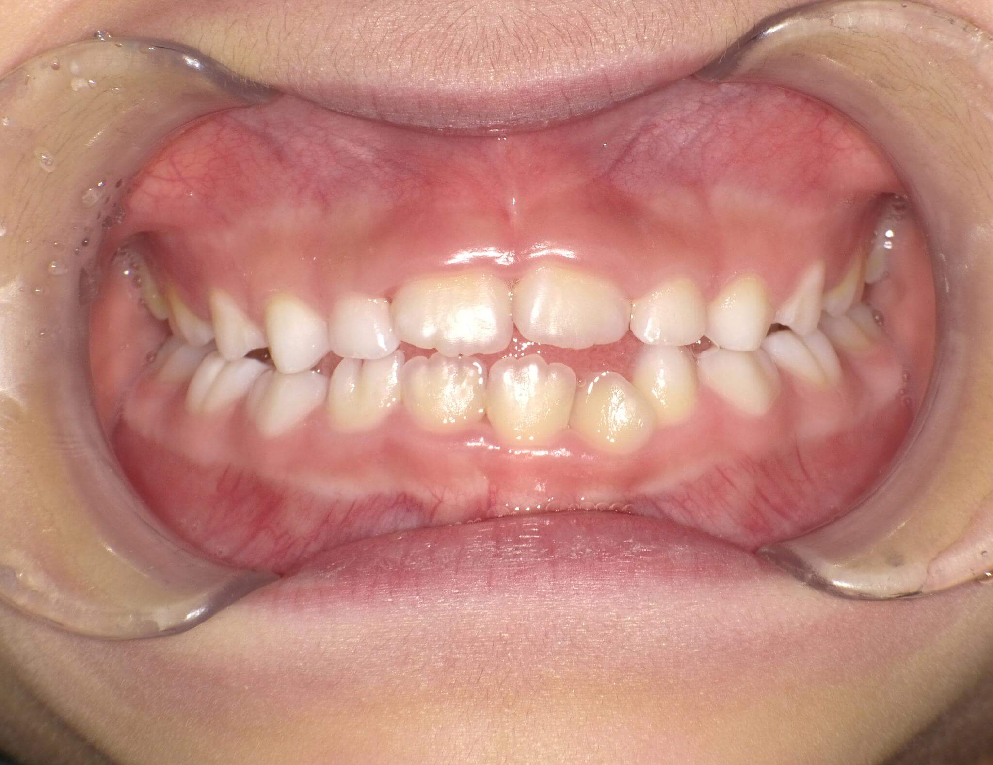歯茎の見え方が変わった症例