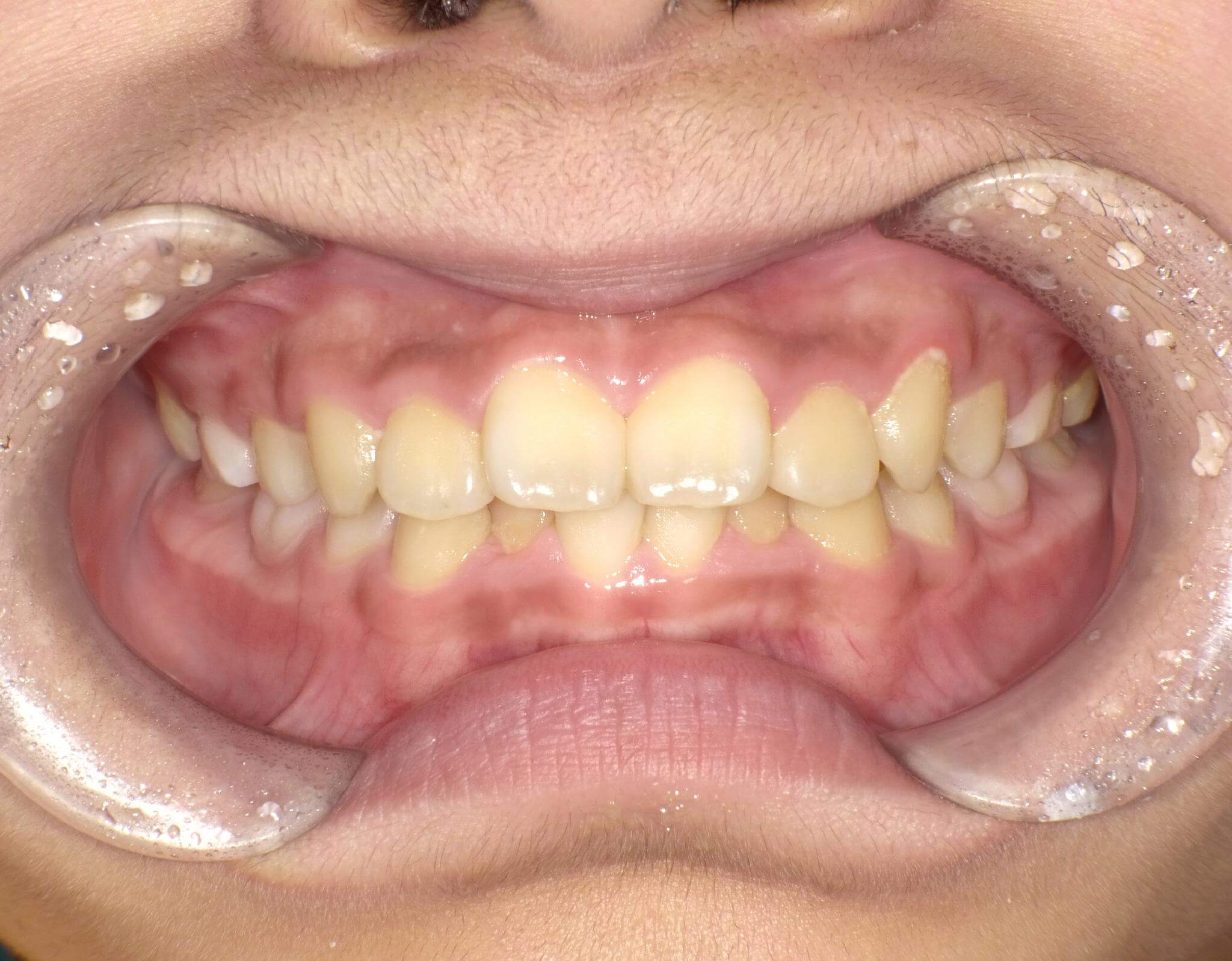 出っ歯とガタガタ歯列が改善！