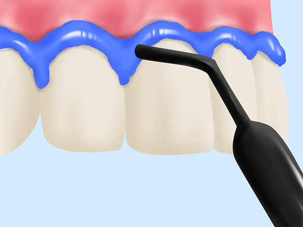 歯肉の保護